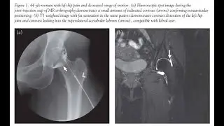 Arthrography; X ray arthrography, CT arthrography, MR arthrography  to evaluate joints