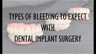 Types of Bleeding to Expect with Dental Implant Surgery | Full Mouth Restoration in Tulsa, Oklahoma