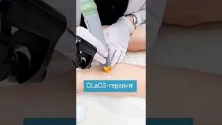 Удаление сосудистых звездочек на ногах лазером Cutera Xeo. Процедура ClaCs!