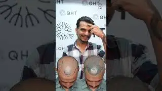 Three Years Hair Transplant Results | Latest Fue Technique #shorts #viral #hair transplant