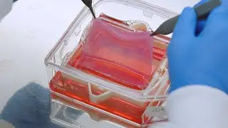 Cutiss - Customised artificial skin for burns victims