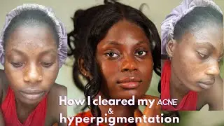 The Dry Skin Solution That ERASED My Acne and Hyperpigmentation!