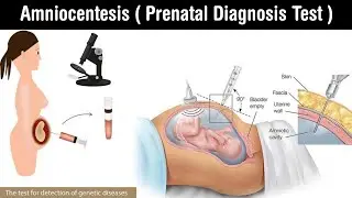 Amniocentesis | prenatal diagnosis test | amniotic fluid | process of amniocentesis in Hindi