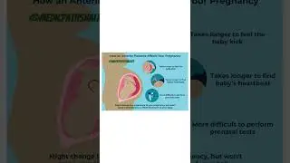 Anterior placenta | Pregnancy #viral #shorts