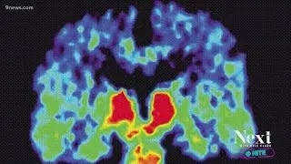 Study: Improving air quality can reduce chance of dementia