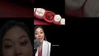 How to avoid dry socket after wisdom tooth extraction. #wisdomtooth #wisdomteeth #drysocket #tooth