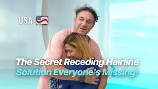 I Tried a Hair Transplant for My Receding Hairline... And It Changed EVERYTHING #sapphirefue