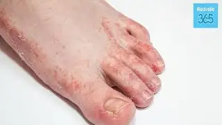 Fight Nail Fungus With This Natural Turmeric Remedy - Australia 365