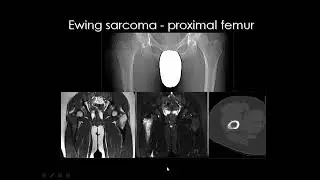 Imaging of Bone tumors II DRE Prof  Mamdouh Mahfouz HD