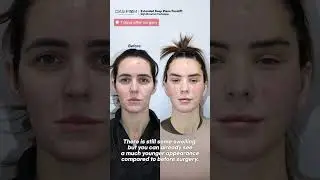 [Real Facelift Vlog in My 40s] Confidence Rediscovered in Korea 4 #facelift  #beforeandafter
