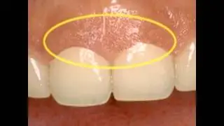Gingivectomy | Lake Merritt Dental, Oakland, CA
