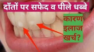 डेंटल फ्लोरोसिस (दांत पर सफ़ेद धब्बे)Dental fluorosis,symptoms & its solutions-Dr.praveen Bhatia