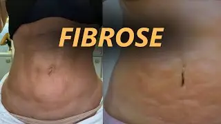 FIBROSE - O que &eacute;? Por que acontece? E como EVITAR ap&oacute;s a lipoaspira&ccedil;&atilde;o? CIRURGIA PL&Aacute;STICA