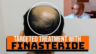 Finasteride Targeted Treatments - Will it work?