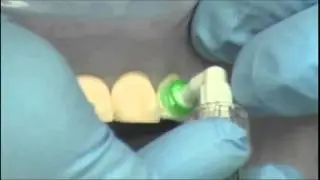 ICON - Treatment for Caries, White and Brown Spot Lesions without Drilling