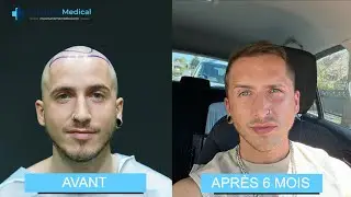 Greffe de cheveux Turquie Dhi avant et après résultat a 6 mois | Turkisme Médical