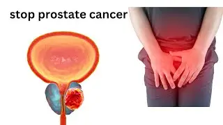 6 surprising things that can stop prostate cancer. (How to stop prostate cancer fast)