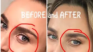 VIVACE DEMO!! ⚡️Micro needling w/ radio frequency 🎛 before and after pics & esthetician review💁‍♀️
