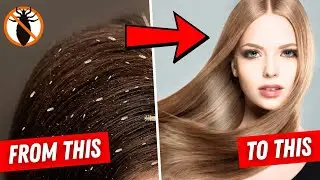 How to Get Rid of Lice PERMANENTLY! ✅ Natural Remedy That Works FAST