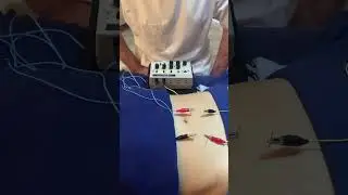 Electro Acupuncture Diastasis Recti Abdominis #integratedmanualmedicine #immcpd
