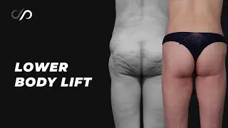 Amazing 8 Day Body Lift Results That Will Blow Your Mind!