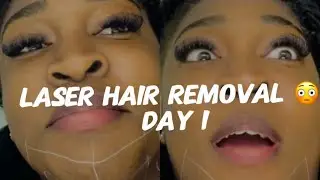 Getting Laser Treatment: A Day in My Life🫣