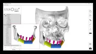 ENHANCE LITE v1.4.0: Fibula Osteotomy for Mandible