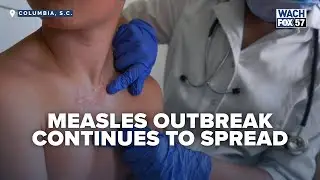 Nearly 1,000 at Risk After Potential Measles Exposure in Columbia