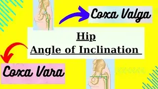 Coxa vara & coxa valga biomechanics in detail with notes