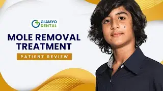Mole removal treatment happy patient review video | Glamyo Health hain surgery ka  naaya address