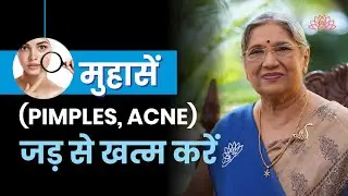 Adopt home remedies to remove acne, blemishes and spots | Acne and Pimples | Spotless Glowing Skin