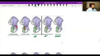 Judet and Letournel classification | Acetabular Fracture Classification
