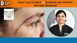 BEST SCAR REMOVAL - Laser scar revision vs Surgical scar revision - Dr.Amee Daxini | Doctors' Circle