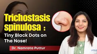The Real Reason Your Nose Black Dots Won&rsquo;t Go Away! | Trichostasis Spinulosa Explained | Clear Skin
