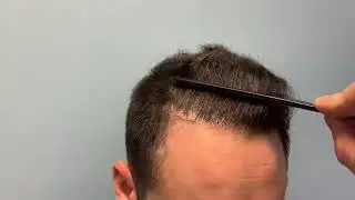 ⭐⭐ ⭐Case #152 - &Delta;&epsilon;ί&tau;&epsilon; &tau;&omicron; &alpha;&pi;&omicron;&tau;έ&lambda;&epsilon;&sigma;&mu;&alpha; &mu;&epsilon; 2000 FUs - Anastasakis Hair Clinic