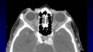 Imaging of the Eye and Orbit, Part 4