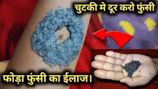 फोड़ा फुंसी का ईलाज | जबरदस्त ईलाज घर पे फोड़ा फुंसी हटाने का | Phunsi ka ilaj Ghar pe kaise kare