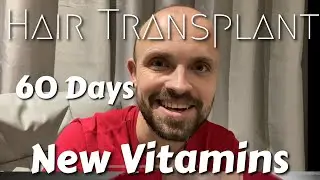 Day 30, hair transplant, multi vitamin change