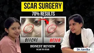 Successful Trauma Scar Surgery ll Before After ll #dranvika #skincare  