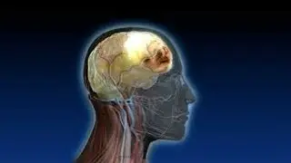 Epidural Hematoma ICD 9
