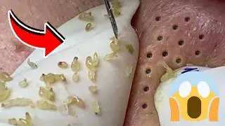 EXTRA&Ccedil;&Atilde;O DE CRAVOS SATISFAT&Oacute;RIA | LIMPEZA DE PELE COMENTADA POR ESTETICISTA! #356423