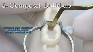 Class II Composite Restoration on MODEL