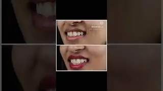 Smile makeover by doing multiple cavities in front teeth. #smiledentist  #gorgeoussmilesdentist