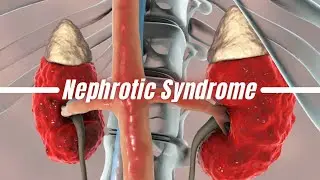 NEPHROTIC SYNDROME ￼