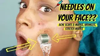 Dermaroller for DARK SPOTS | Tumeric Mask for Acne & Scarring