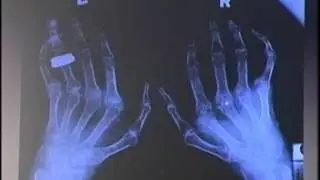 Rheumatoid Arthritis by Professor Chit Soe