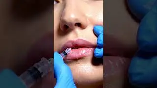 Lip Filler Transformation | Realistic Cosmetic Enhancement