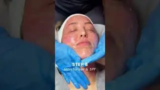 ✨ Experience the 8 Steps of a Microneedling Treatment at Restore Hyper Wellness! ✨