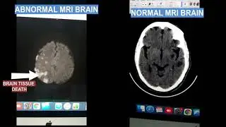 MRI BRAIN SHOWING STROKE