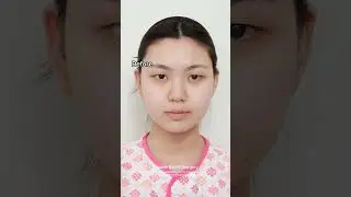 I decided to get double eyelid surgery in Korea #plasticsurgery #korea #seoul #monolid #asian #fyp